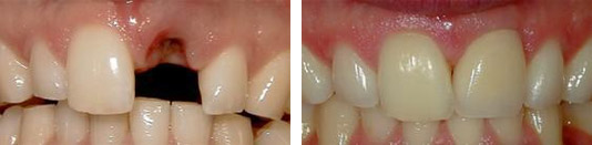 Before and After Dental Implants and Crowns Photo