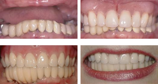 Before and After Dentures, Dental Implants, and Crowns Photo