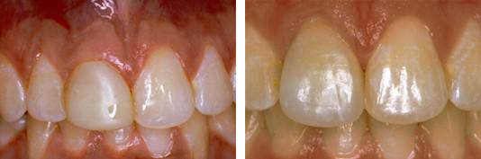 Before and After Porcelain Crowns Photo