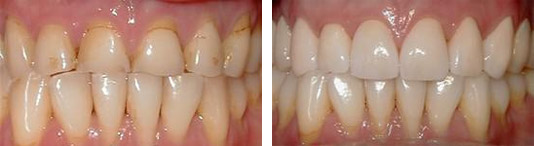 Before and After Porcelain Crowns Photo
